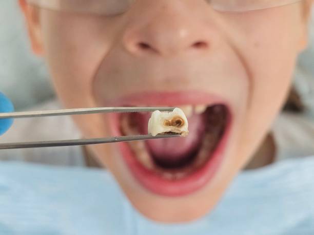 Best Urgent Tooth Repair  in Napa, CA
